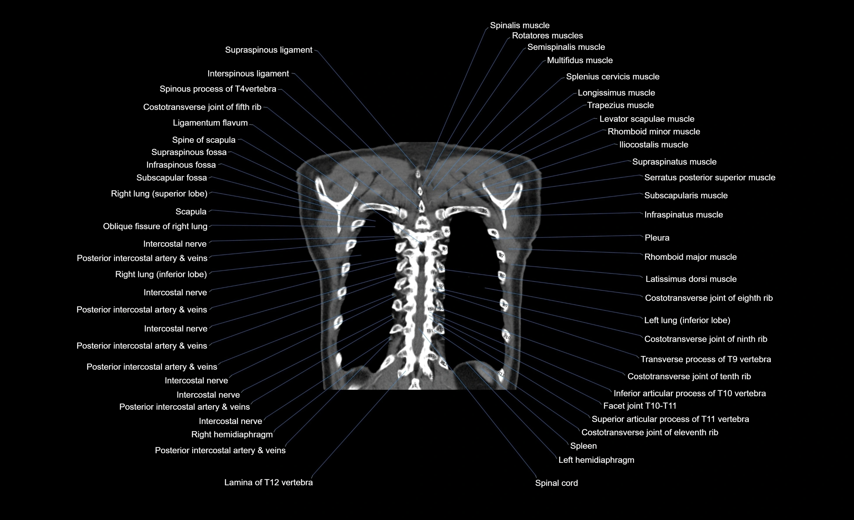 CT chest (thorax) labelled coronal cross sectional anatomy radiology image-00021.webp